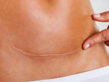 Nếu đã từng đẻ mổ, chị em lưu ý nguy cơ thai bám sẹo mổ lấy thai