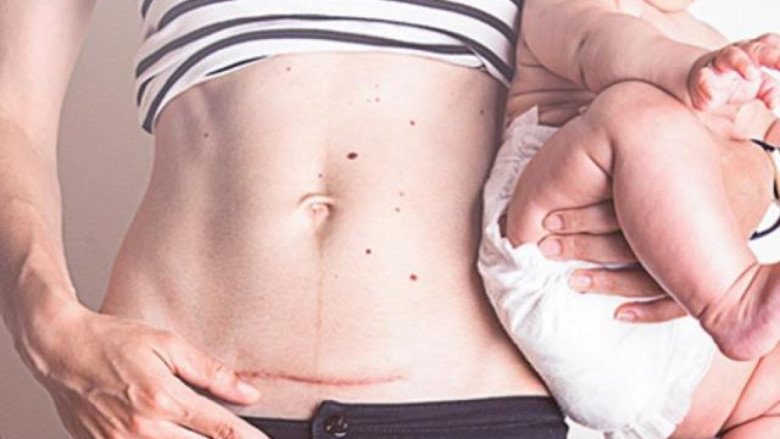 Nếu đã từng đẻ mổ, chị em lưu ý nguy cơ thai bám sẹo mổ lấy thai - 1