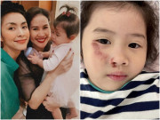 Làm mẹ - Con gái Thân Thúy Hà bị ngã xe trầy xước hết mặt mũi khiến Tăng Thanh Hà, Quang Dũng xót xa