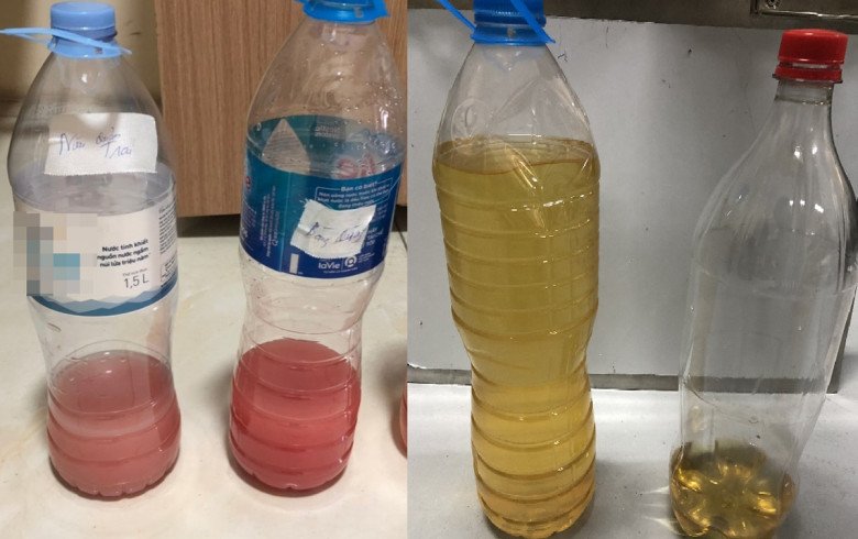 Hình ảnh nước tiểu bà Ba trước (bên trái) và sau khi phẫu thuật (bên phải) 1 tuần. Ảnh: BSCC.