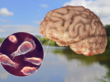 Người đàn ông tử vong do nhiễm vi khuẩn ăn não người - bệnh 100 người nhiễm chỉ 3 người sống sót