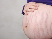 Bà bầu - Cách phòng ngừa rạn da khi mang thai