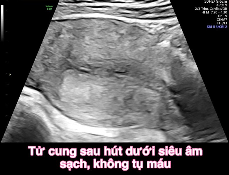 Bác sĩ đã cố gắng hút lại dưới siêu âm. (Ảnh: BSCC)