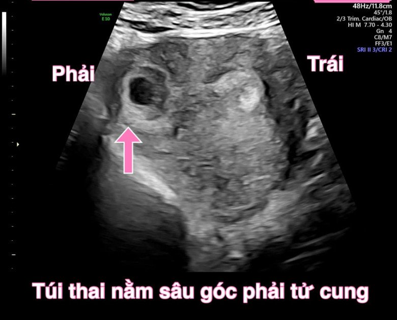 Phát hiện túi thai lưu nằm sâu trong góc phải tử cung. (Ảnh: BSCC)