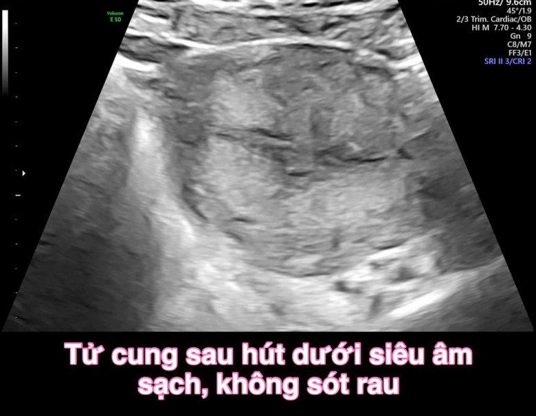 Không may bị thai lưu, người vợ trẻ ám ảnh 3 lần đình chỉ thai nghén mới thành công - 3