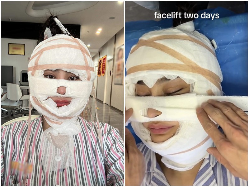 Mới đây, Lâm Khánh Chi bất ngờ sang Trung Quốc để làm đẹp, cô tiết lộ hành trình tìm lại thanh xuân bằng phương pháp căng da mặt. Trong ảnh, nữ ca sĩ chuyển giới được băng bó kín mặt, đủ thấy sự đau đớn khi thực hiện ca phẫu thuật đến đâu.
