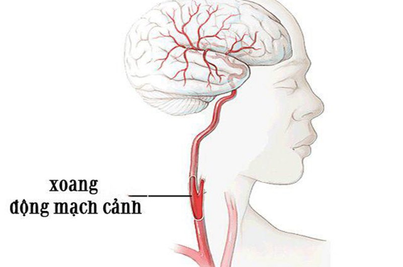 Xoang động mạch cảnh ở cổ, nằm tại vị trí khoảng phần sụn giáp, có các dây thần kinh với tác dụng điều tiết, khống chế huyết áp và nhịp tim. Khi khu vực này bị ngoại lực tác động mạnh có thể gây thiếu máu lên não, khó thở.
