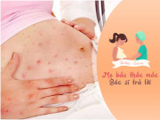 Bà bầu - Mẹ bầu bị sốt xuất huyết có phải đình chỉ thai kỳ?