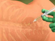 Bà bầu - 7 tác dụng phụ của gây tê tuỷ sống và cách khắc phục