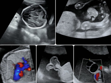 Đi siêu âm đúng ngày 20/10, nghe bác sĩ báo thai dị tật, vợ chồng hiếm muộn 7 năm khóc nghẹn