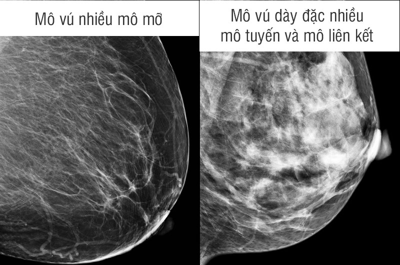 Bác sĩ người Đài Loan (Trung Quốc), Jiang Kunjun - chuyên gia ung thư cho biết nghiên cứu cho thấy phụ nữ có mô vú dày đặc có nguy cơ mắc ung thư vú cao hơn. Tuy nhiên, các nhà khoa học không biết chắc tại sao điều này lại xảy ra.  

