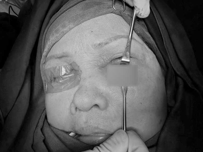 Sau 1 tuần điều trị, tình trạng viêm tấy giảm và bắt đầu hình thành ổ hoại tử. Bệnh nhân được phẫu thuật tháo mủ, làm sạch tổ chức hoại tử, chăm sóc tại chỗ. Tình trạng hoại tử không tiến triển tăng lên nhưng kéo dài, cần phải có những can thiệp cắt lọc, làm sạch mô tổn thương, kích thích liền vết thương.