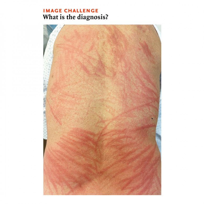 Người đàn ông nổi những vết đỏ trên da trông giống như bị đánh.