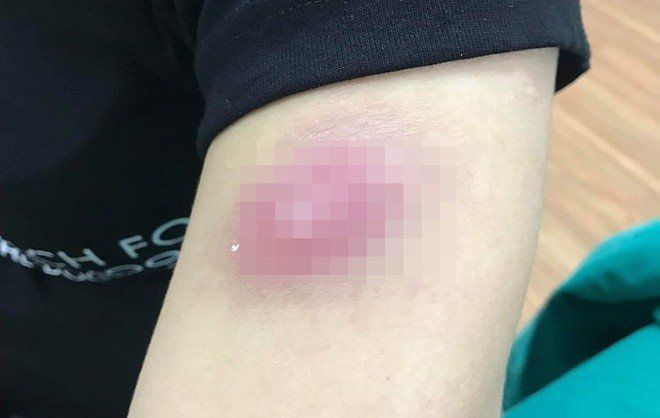 Chi 30 triệu đồng để đánh tan mỡ, cô gái trẻ ở Hà Nội nhận về chi chít u cục khắp cơ thể - 1
