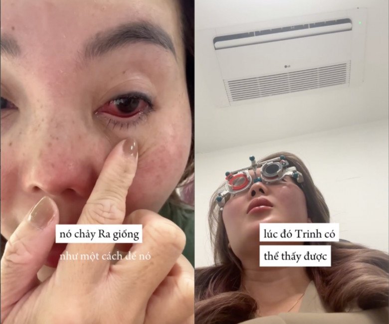 Mắt của nữ beauty blogger bị giảm thị lực vì bị bỏng do hoá chất ở keo nối mi.