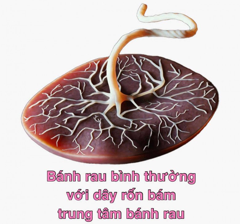 Mổ đẻ xong nhìn bánh rau lạ của mình, sản phụ thốt lên kinh ngạc