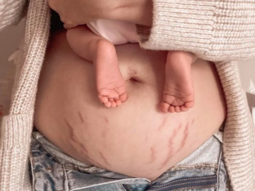Mách các mẹ 1 số thực phẩm nên ăn để làm mờ vết rạn da sau sinh
