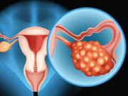 Sức khỏe - Khi ung thư buồng trứng "gõ cửa", cơ thể dễ có 5 tín hiệu này nhưng nhiều phụ nữ lại ngó lơ