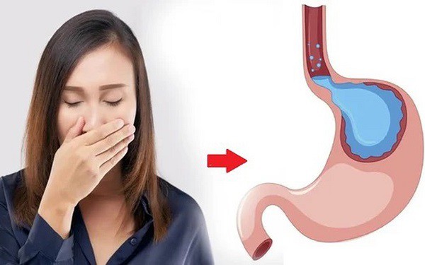 Tại sao mùa lạnh hay bị trào ngược dạ dày hơn? Trào ngược dạ dày có dẫn tới ung thư? - 2