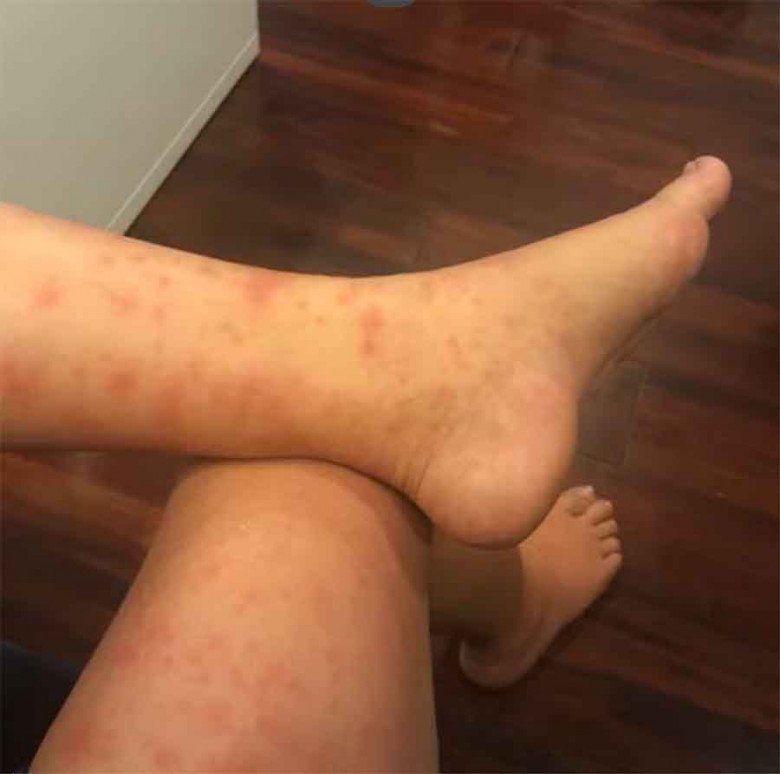Mẹ bầu ham ăn hải sản bị ngộ độc thai kỳ chưa từng có tiền lệ tại viện, sau sinh điều kỳ diệu đã xảy ra - 2