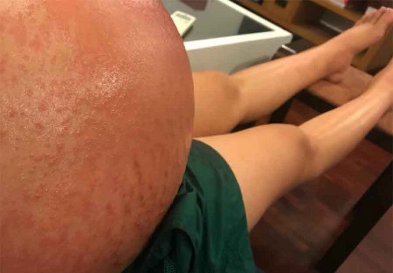 Lúc gần sinh chị Trang Anh bị ngộ độc thai nghén nặng.