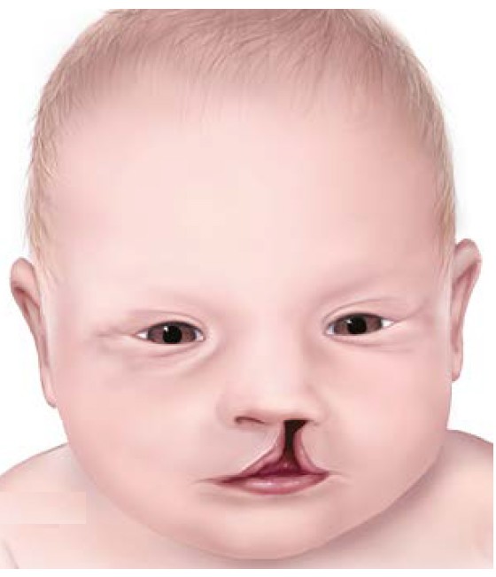Hình ảnh mô tả trẻ bị dị tật bẩm sinh sứt môi - hở hàm ếch.