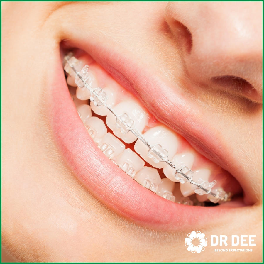 Niềng răng mắc cài sứ - cách vệ sinh đúng
