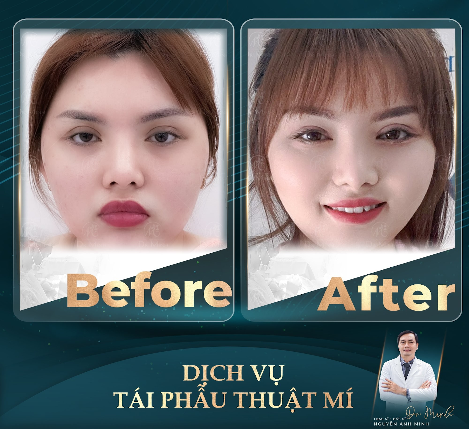 Dr. Minh - Chuyên gia tái phẫu thuật mí: Hồi sinh đôi mắt, hồi sinh tự tin! - 2