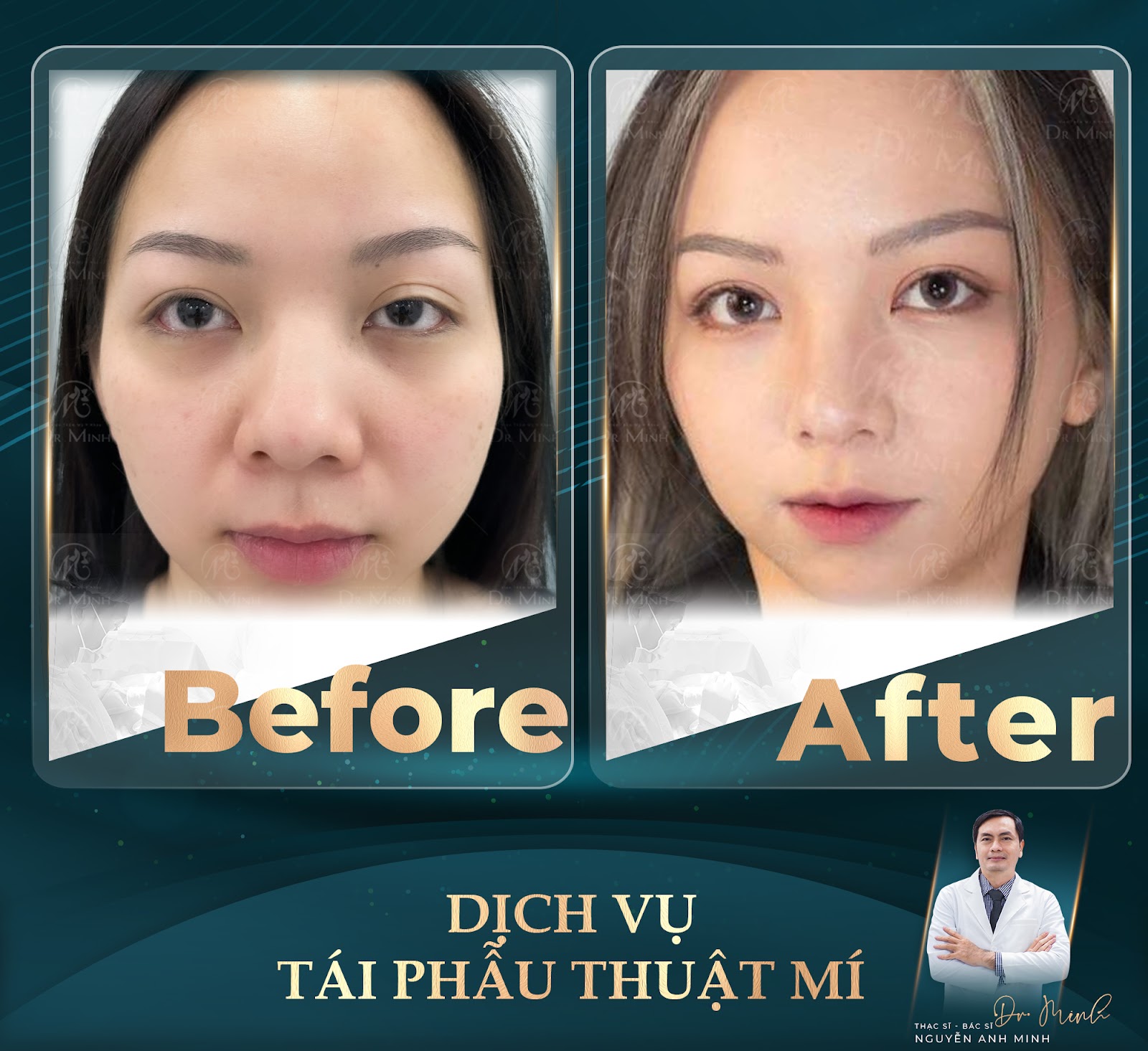 Dr. Minh - Chuyên gia tái phẫu thuật mí: Hồi sinh đôi mắt, hồi sinh tự tin! - 3