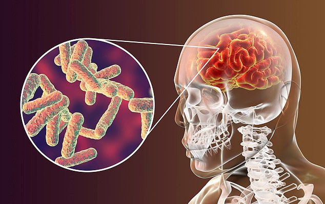 Sự viêm nhiễm lây lan ở bệnh nhân viêm xoang có thể dẫn đến viêm màng não