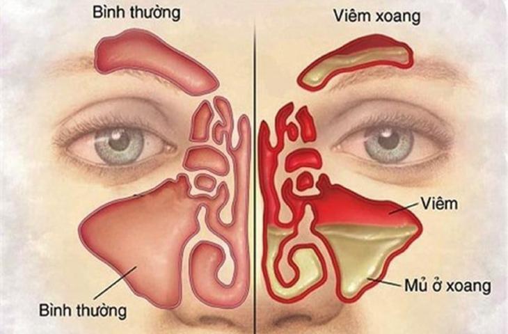 Viêm xoang - căn bệnh nguy hiểm chưa được quan tâm đúng cách