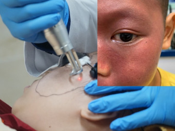 Bé trai gặp người lạ là chạy, sợ không dám tới trường vì bạn chê ở bẩn khi trên mặt có thứ này