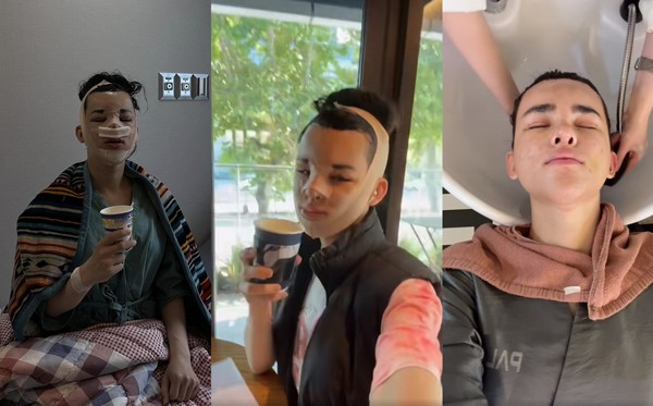 Trần Đức Bo không ngần ngại chia sẻ về thời gian bản thân đi trung tu nhan sắc ở Hàn Quốc. Mặc dù gương mặt được băng bó và sưng bầm nhưng vẫn thoải mái quay video hay chụp hình.