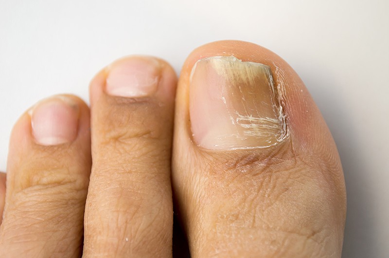 Trọng lực kéo chất độc xuống phía dưới cơ thể và móng chân là thứ phải chịu đựng. Nếu bạn thường đi tất và giày, các ngón chân sẽ thường ở trong môi trường nấm dễ phát triển. Cùng với độc tố sẽ khiến móng chân ngày càng xấu. 

