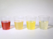 Sức khỏe - Sáng thức dậy thấy nước tiểu màu này đừng vội mừng, hãy đi viện gấp, BS chỉ cách nhìn nước tiểu biết thận khỏe, yếu