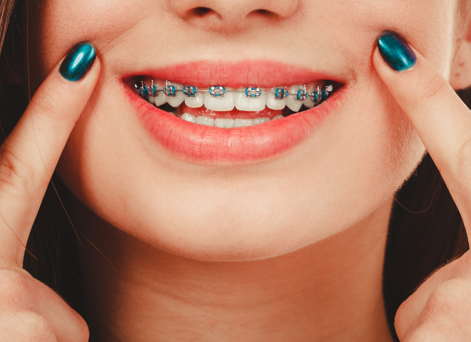 Chị em đồng niềng lựa chọn phương pháp chỉnh nha để có hàm răng đều đẹp.