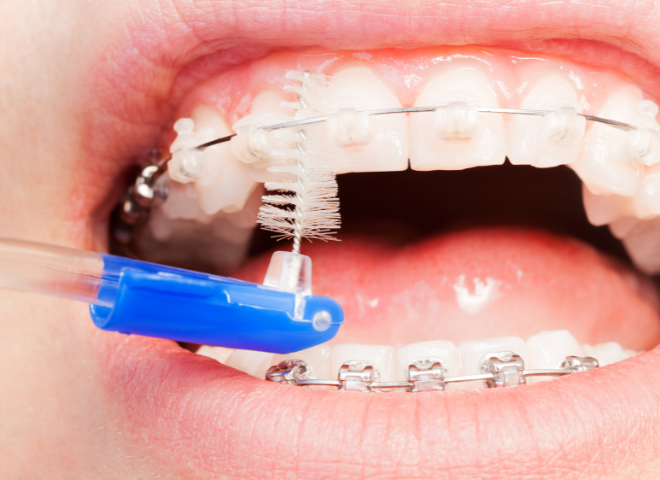Các mắc cài khi gắn vào tạo thêm nhiều kẽ cho vi khuẩn ẩn nấp, bàn chải kẽ là giải pháp làm sạch hiệu quả.