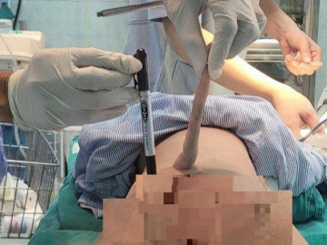 Bé trai 4 tháng tuổi ở Thanh Hóa có đuôi dài 14cm