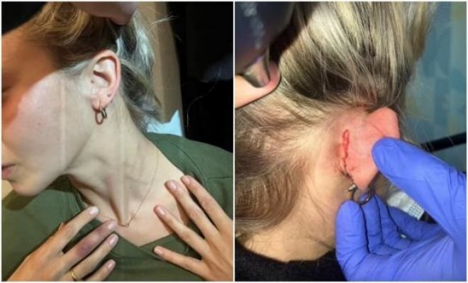 Dấu tích mà Jonathan để lại trên người bạn gái cũ.