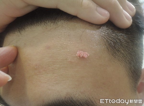 Nam sinh viên có nốt sùi mào gà trên trán nhưng cứ ngỡ là mụn trứng cá.