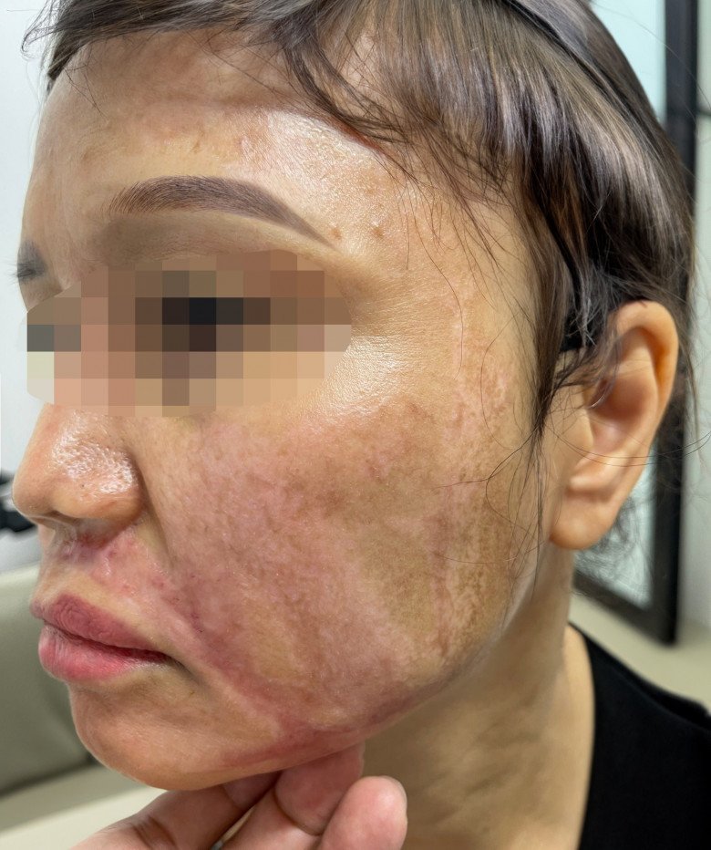 Hình ảnh nữ bệnh nhân bị tổn thương sau khi đi peel da ở spa.