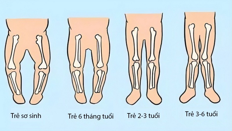 Nếu chân của trẻ bị bó trong thời gian dài sẽ ảnh hưởng đến quá trình lưu thông máu, gây bất lợi cho sự tăng trưởng và phát triển. Tốt hơn hết mẹ nên giúp bé tập các bài tập thụ động, xoa bóp để chân tay bé duỗi ra nhiều hơn và phát triển tốt hơn.
