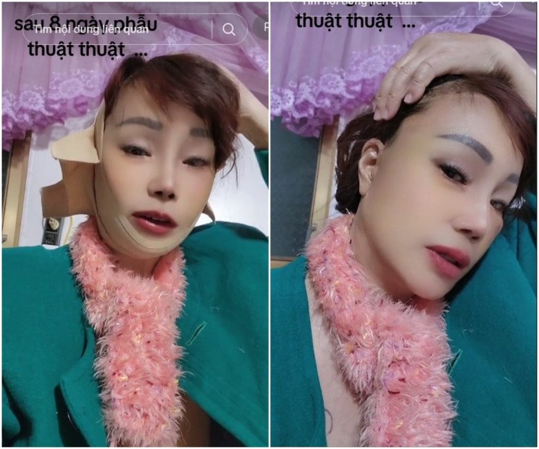 Cô dâu Thu Sao thủ thỉ, bản thân lần này phải tự chăm sóc hậu phẫu vì đã được dặn dò cẩn thận từ đội ngũ bác sĩ. Cô vẫn phải đeo băng nẹp cố định và cho biết, ngày thứ 8 vết mổ chỉ còn hơi sẫm màu, bầm tím đôi chút.