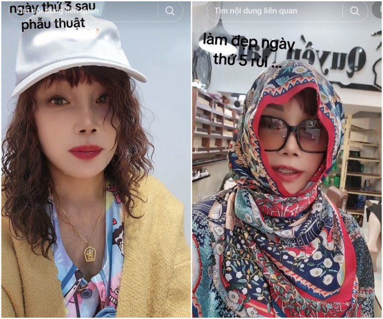 Ngày thứ 3, cô đã được tháo toàn bộ băng mặt. Quay video tương tác, kể chuyện với fans, cô dâu Thu Sao có dùng filter nên không thể đánh giá rõ tình trạng da lúc này, song có thể thấy cử động mặt vẫn chưa hoàn toàn được tự nhiên.