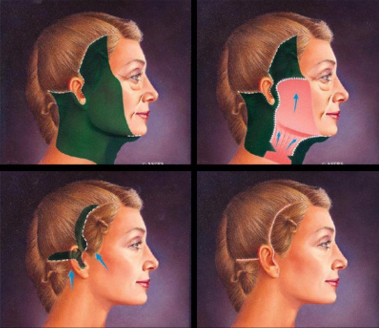 Căng da mặt là phương pháp thẩm mỹ giúp loại bỏ tình trạng chảy xệ lão hoá của vùng da mặt như: da dư, chùng nhão... Kỹ thuật căng da mặt trong thẩm mỹ hiện nay được chia làm 2 nhóm chính là căng da ở vùng mặt và vùng cổ.