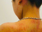 Sức khỏe - Trẻ 7 tuổi ở Hà Giang sốc phản vệ vì thói quen nhiều cha mẹ Việt hay làm mỗi khi bị ho