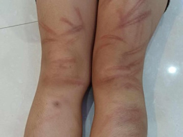 Nhiều trẻ mầm non bị bạn đánh bầm tím cơ thể tại lớp học