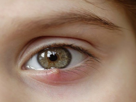 Làm thế nào khi khi "suốt ngày" bị đi bị lại lẹo mắt?