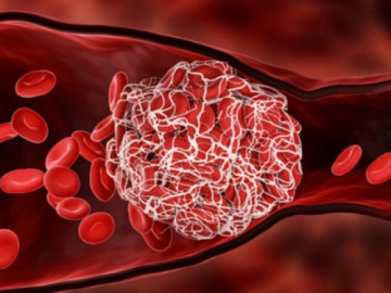 Phụ nữ mang thai nhờ thụ tinh trong ống nghiệm cần làm gì để tránh bị nhồi máu não?