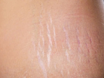 Cách khắc phục 3 vấn đề da thường gặp ở phụ nữ sau sinh